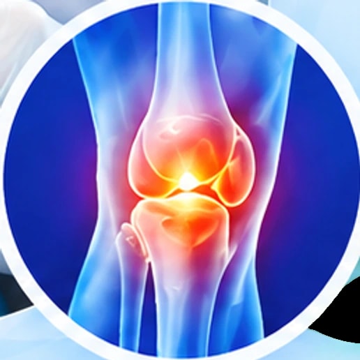 An X-ray style illustration of an inflamed knee joint
